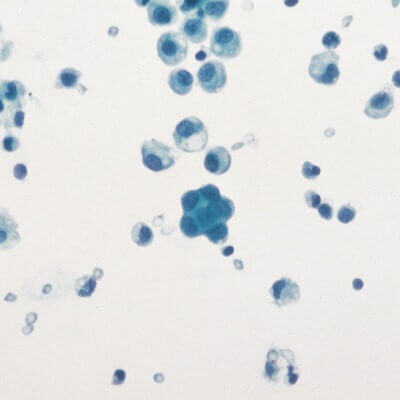 Cells on Microscope Slide (Pleural Fluid)